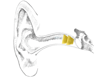 lyric hearing aid in the ear canal